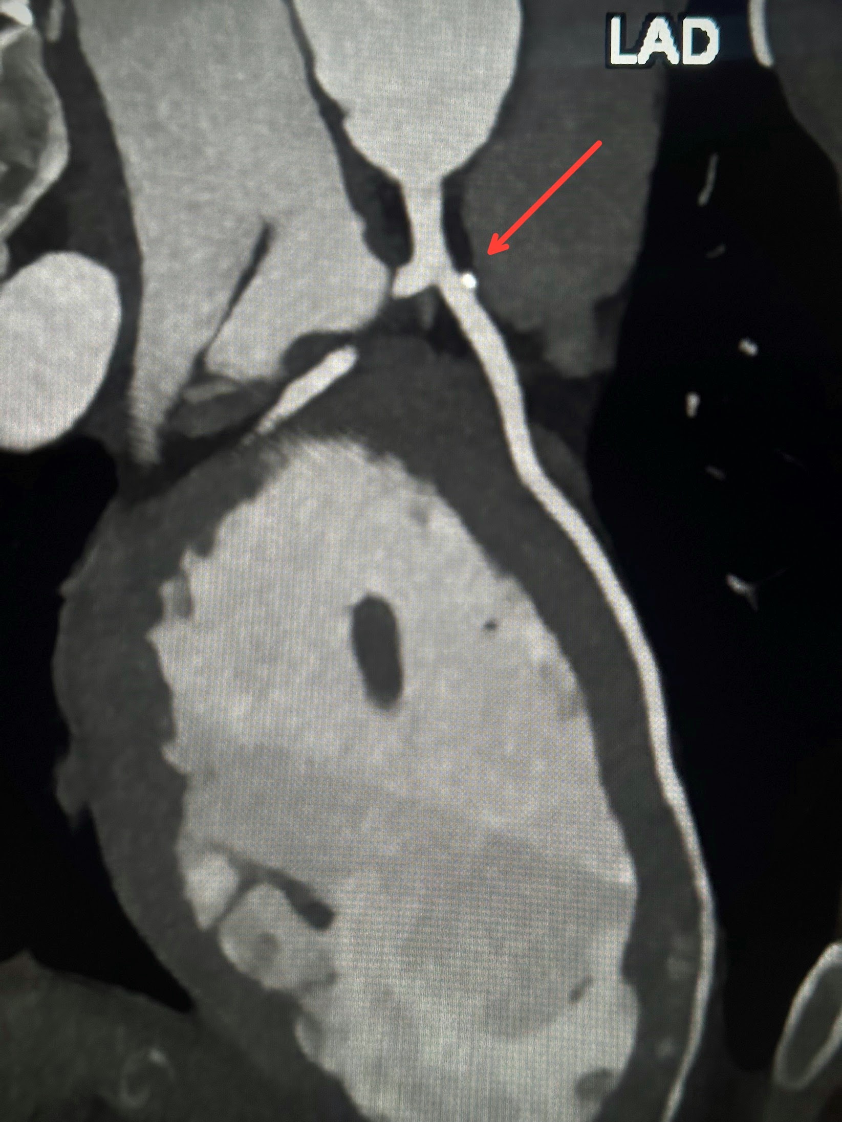 Coronary Artery