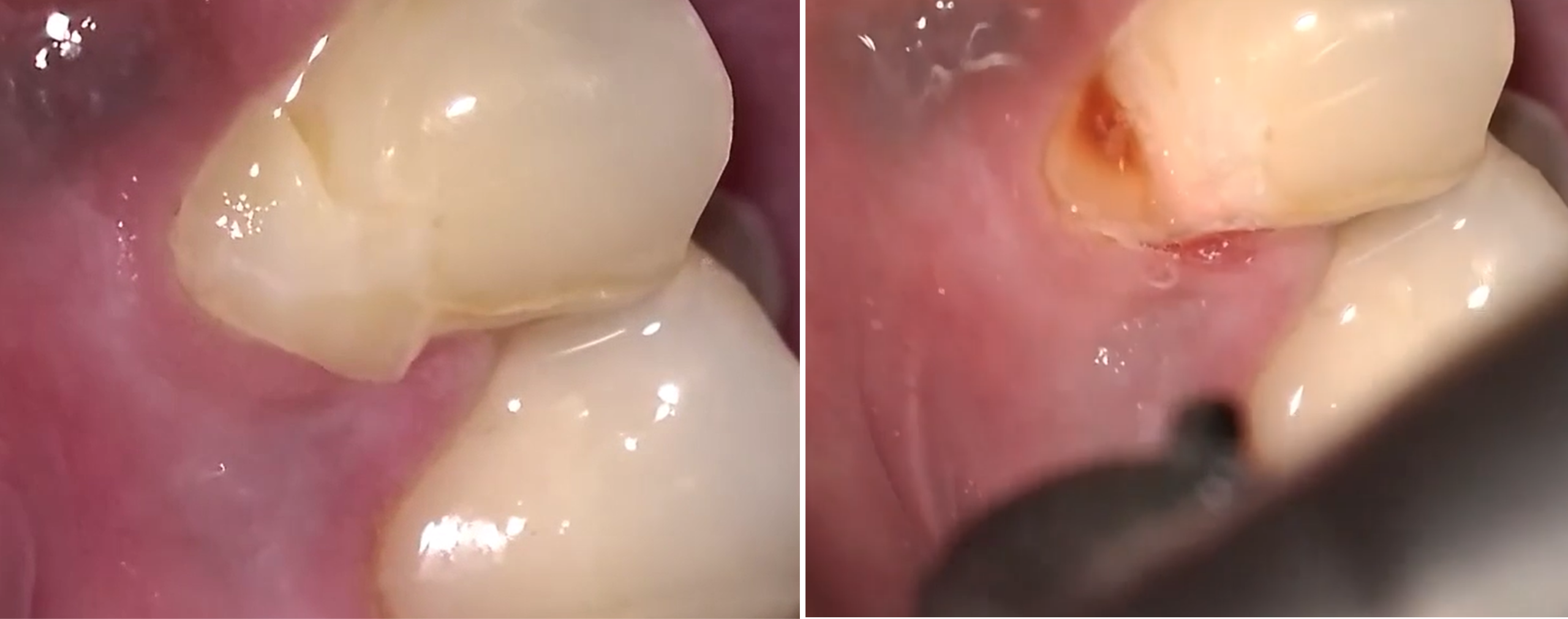 Composite Material Removal