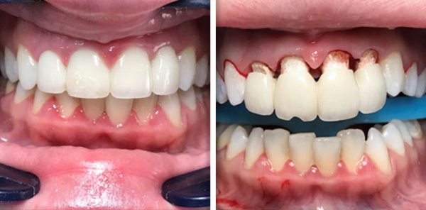 Ceramic veneer bridge removal