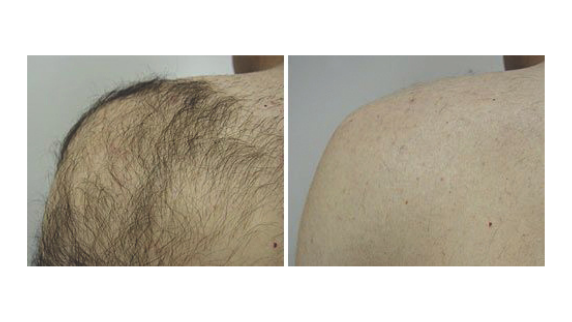 Laser Hair Removal