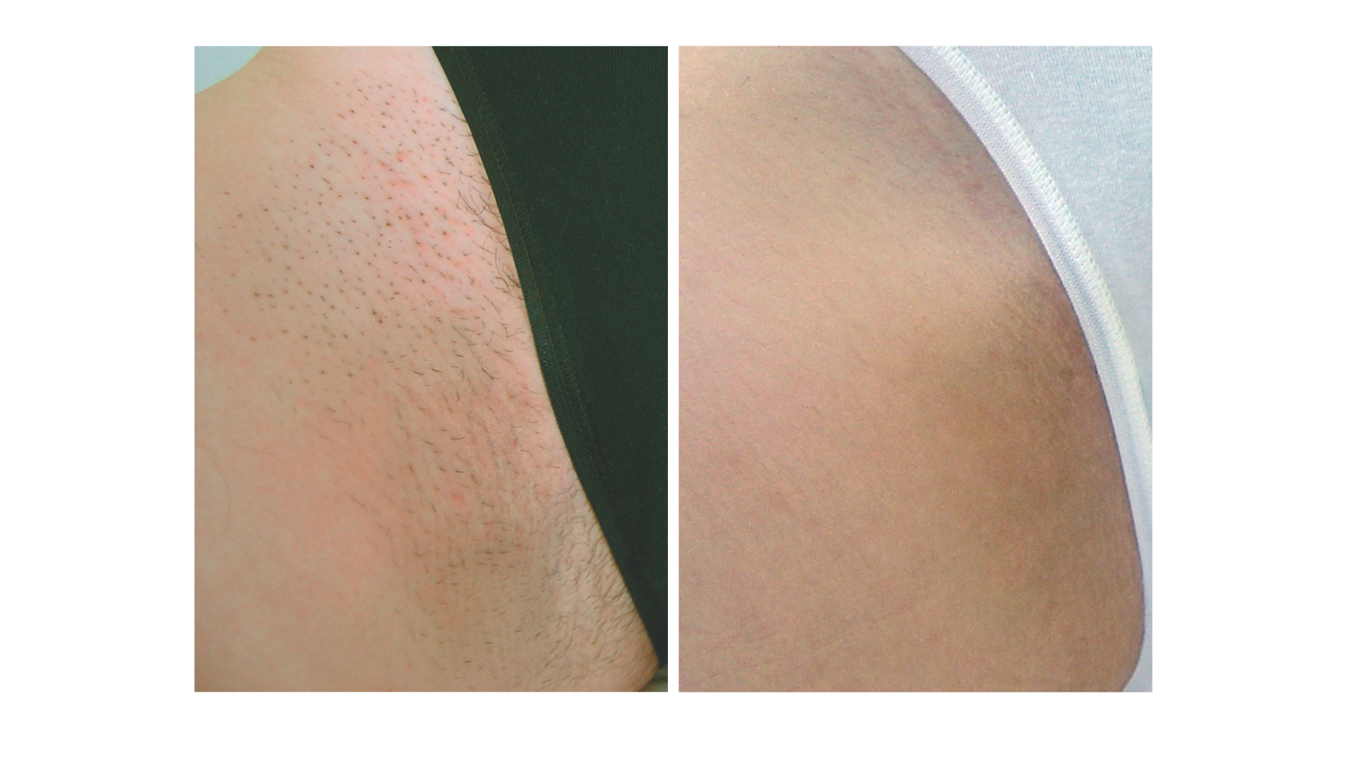 Laser Hair Removal