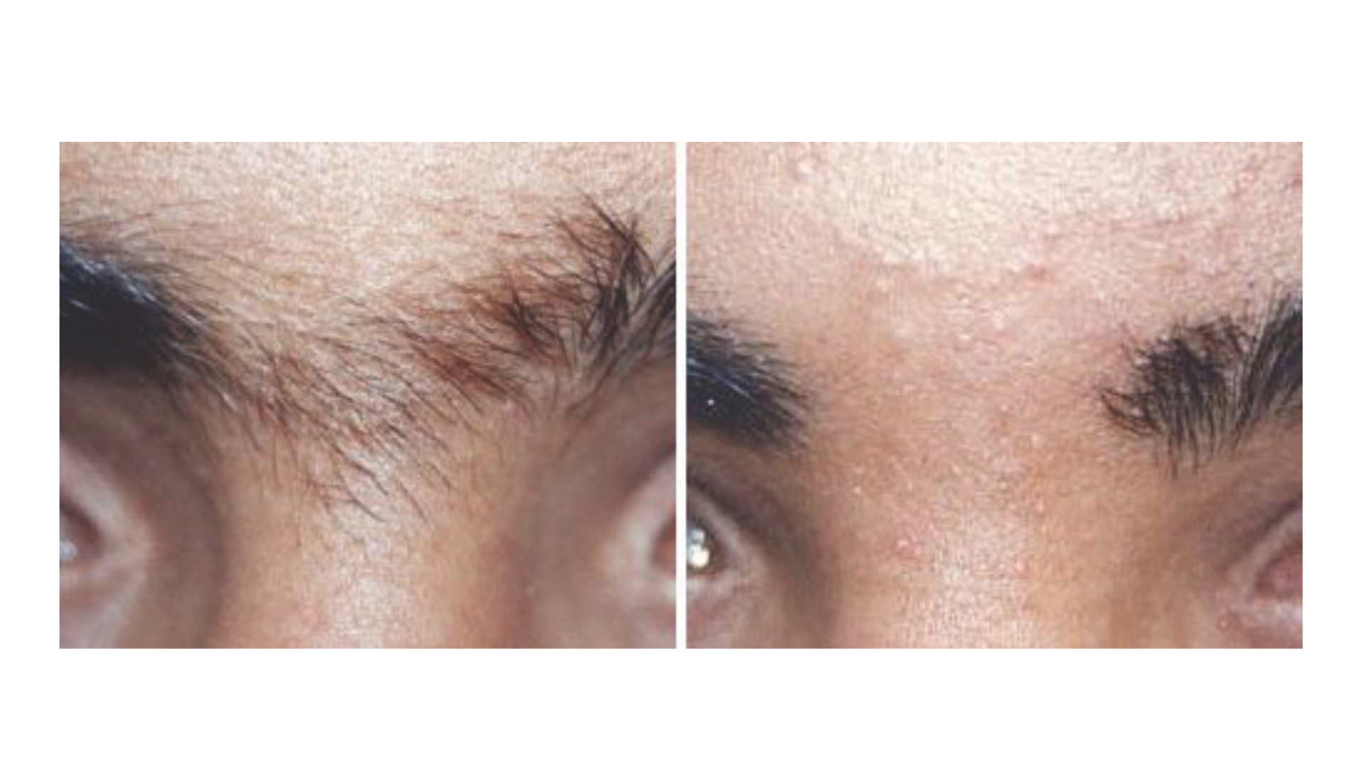 Facial Hair Reduction
