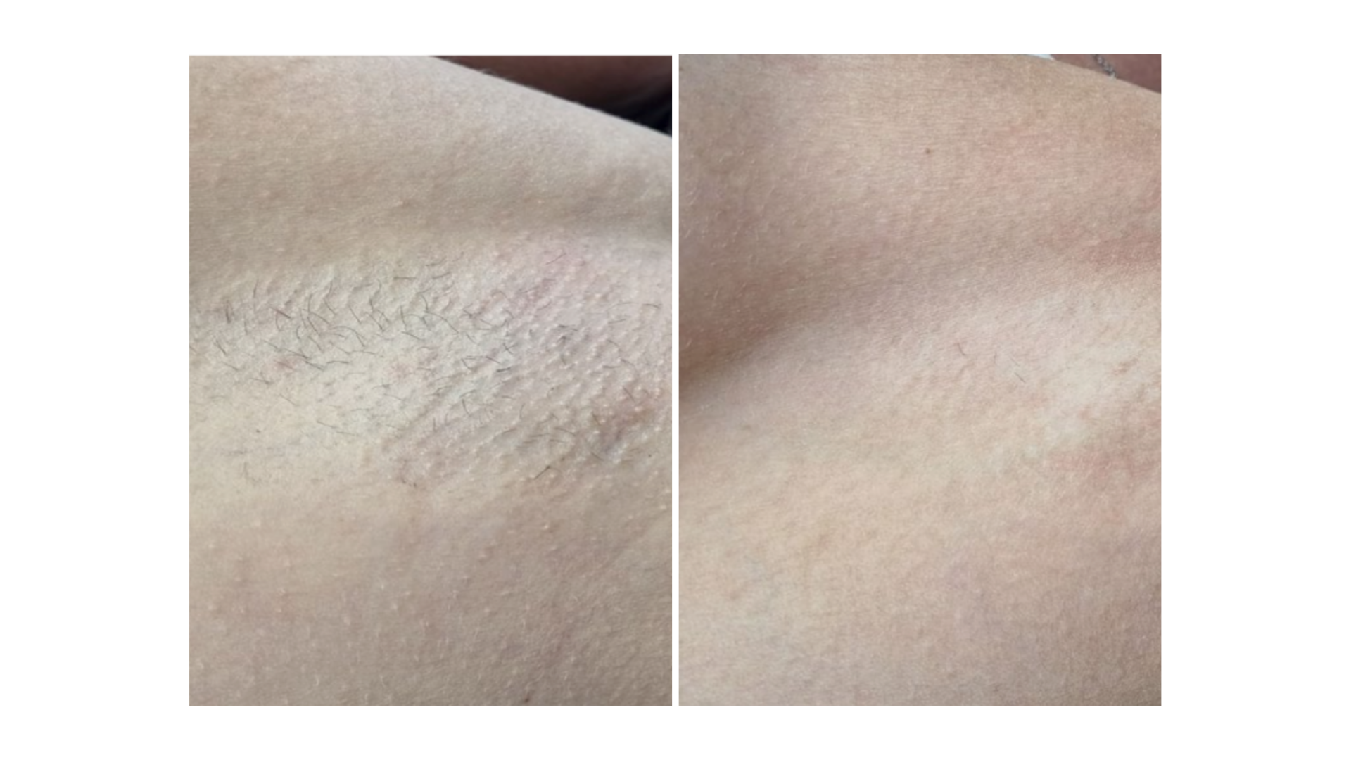 Laser Hair Removal
