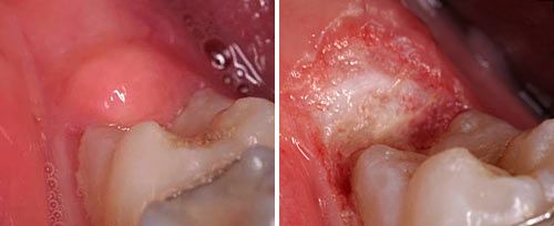 Operculectomy