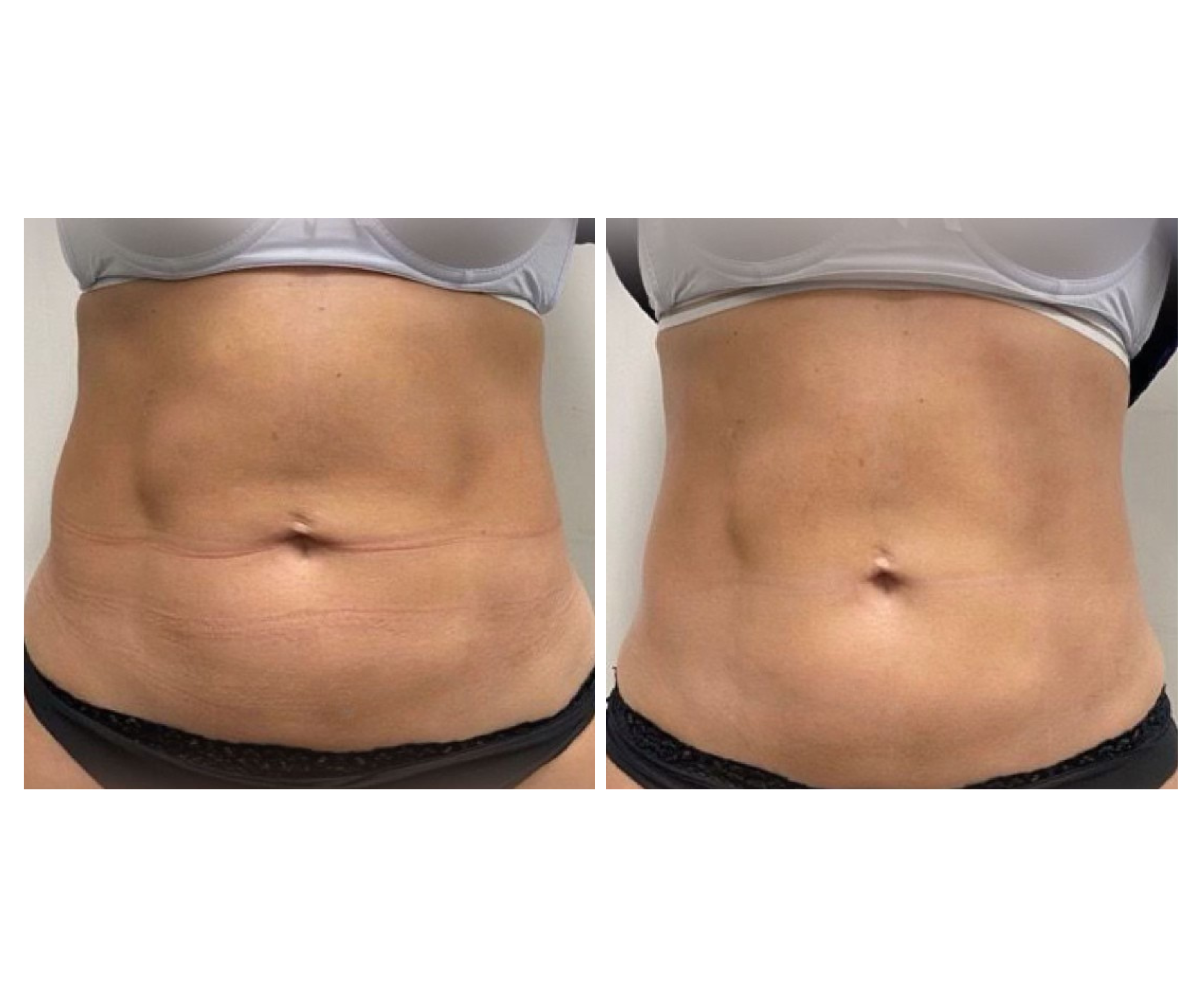 Fotona TightSculpting®