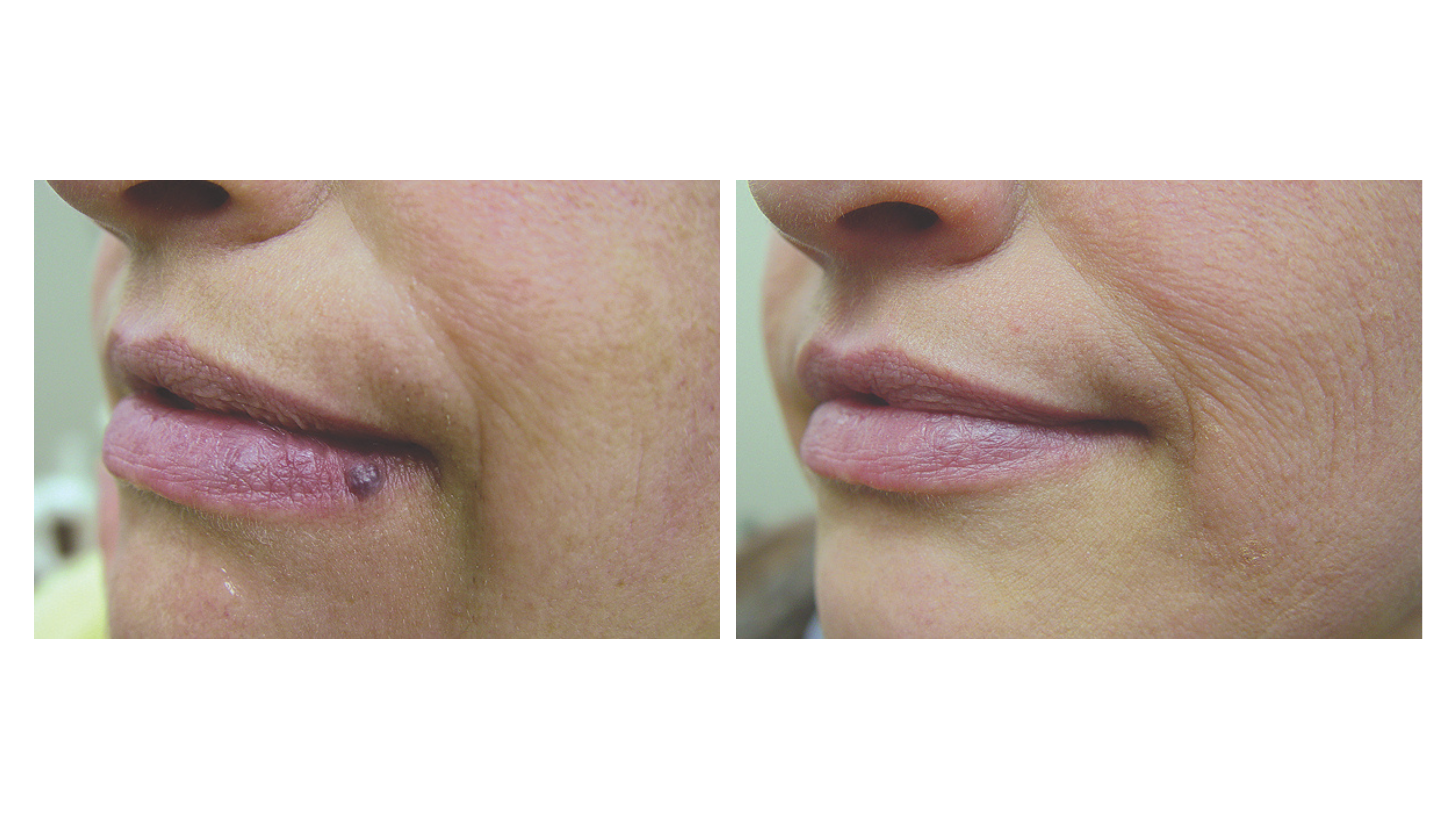 Hemangioma Treatment