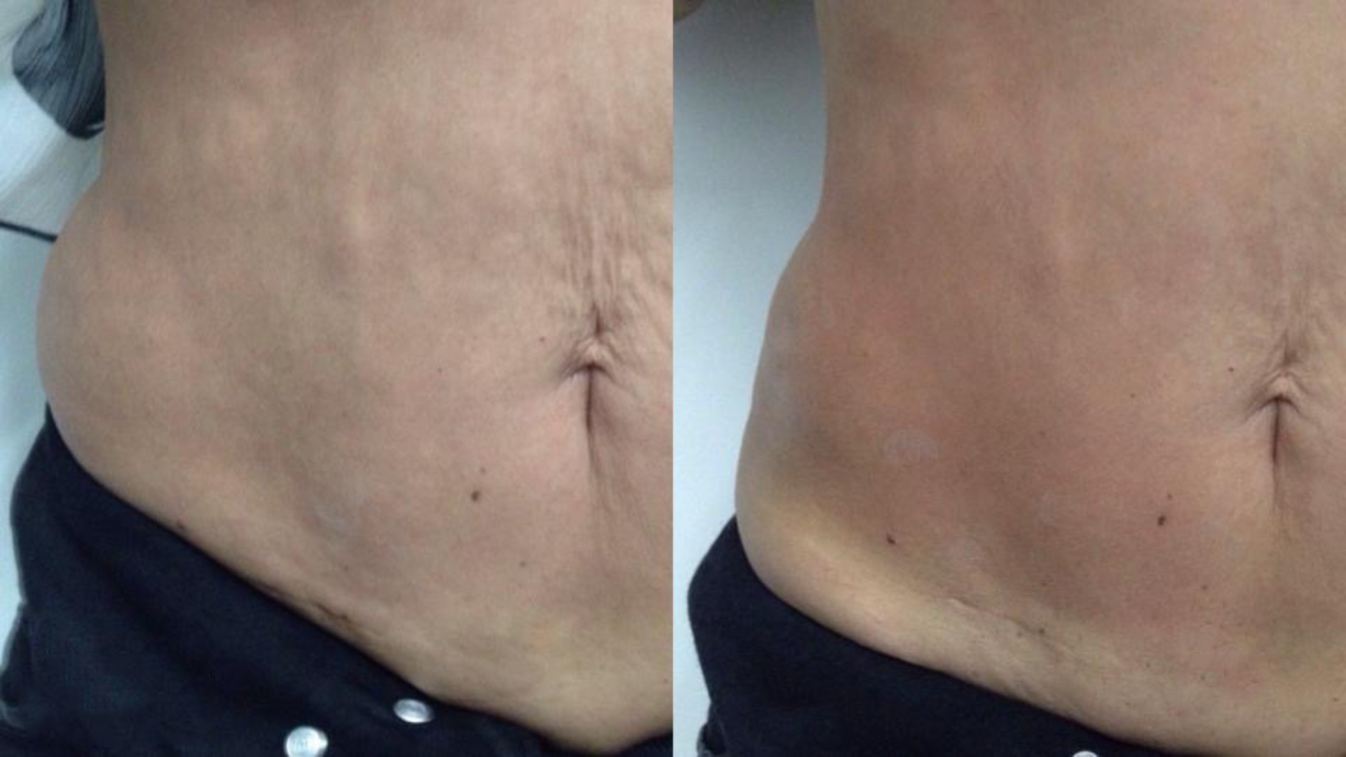 Fotona TightSculpting®