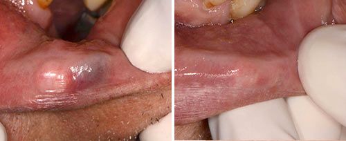 Hemangioma and Fibroma Treatment