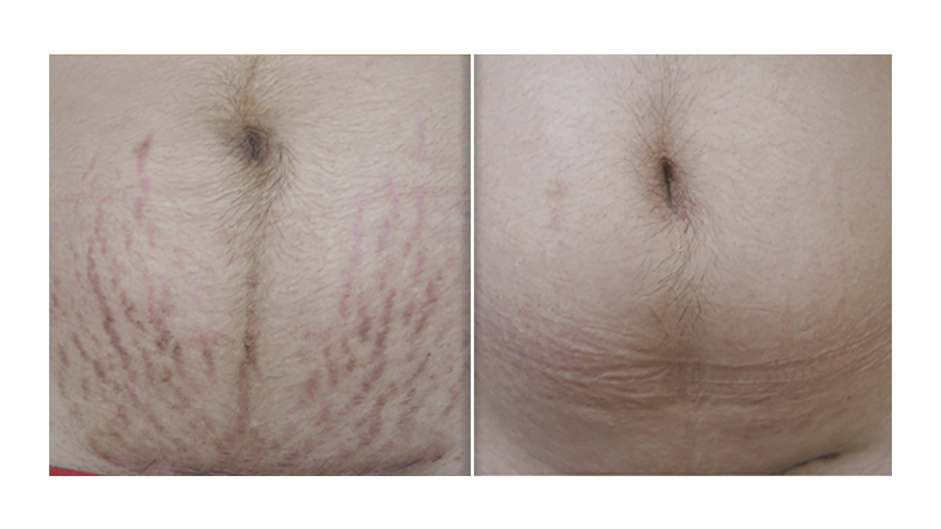 Stretch Mark Revision Treatment