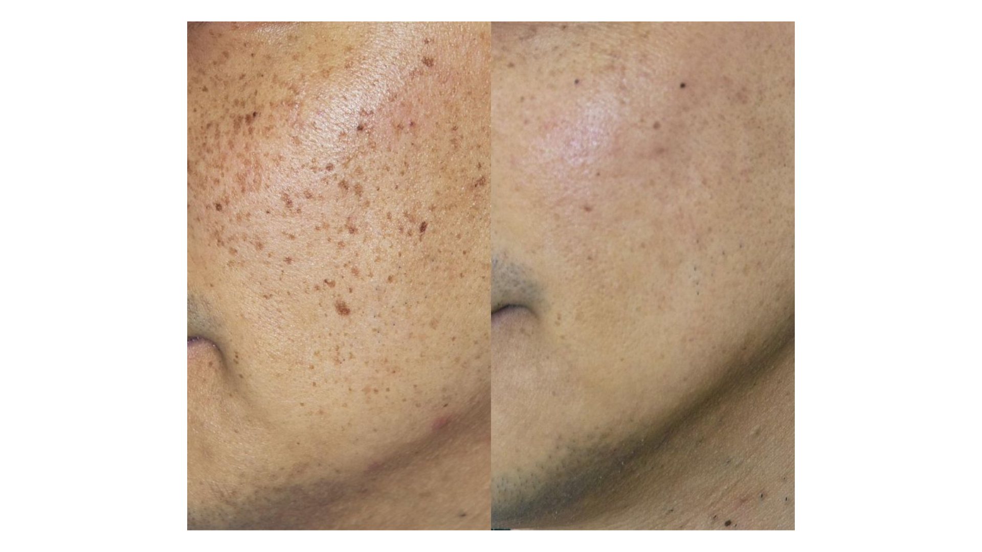 Pigmented Lesions