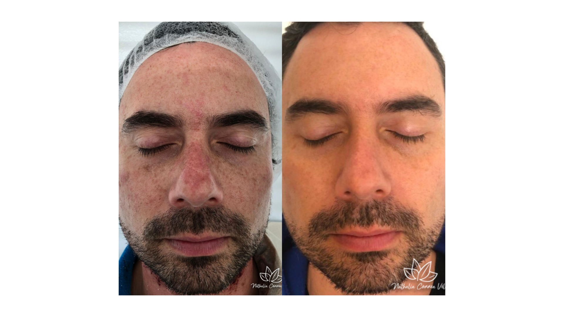 Fotona® Melasma Treatment
