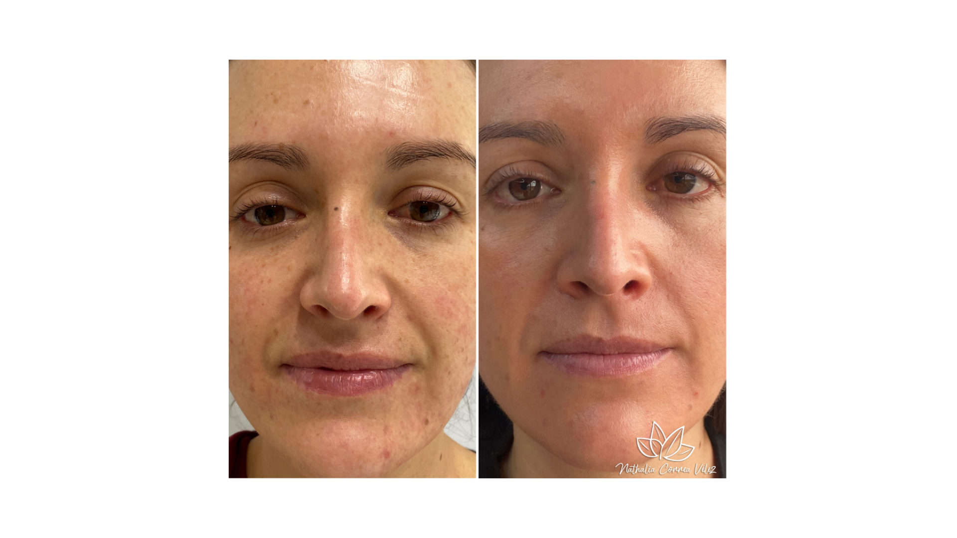 Fotona® Melasma Treatment