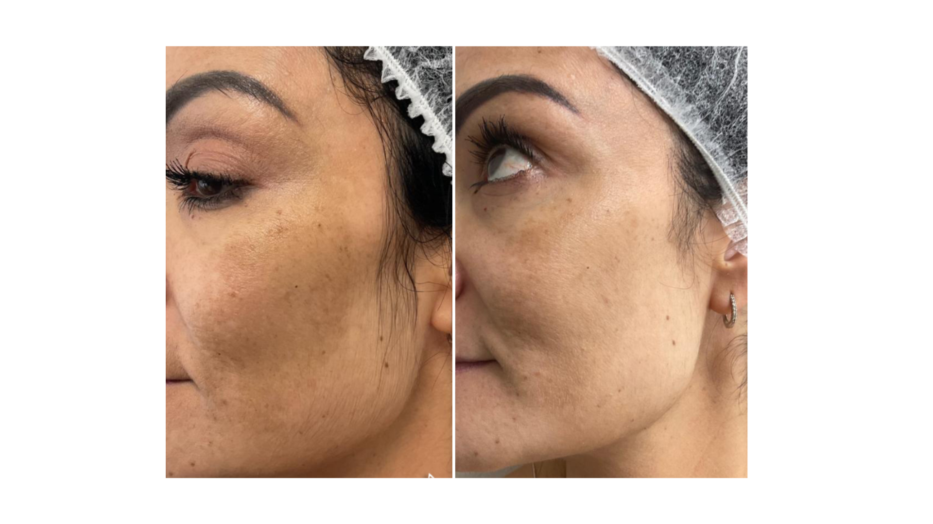 Fotona® Melasma Treatment