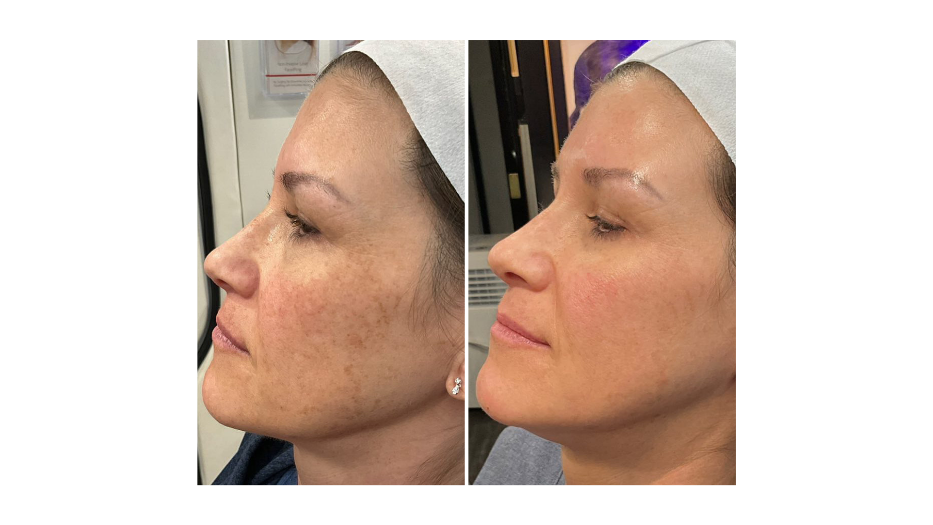 Skin Resurfacing