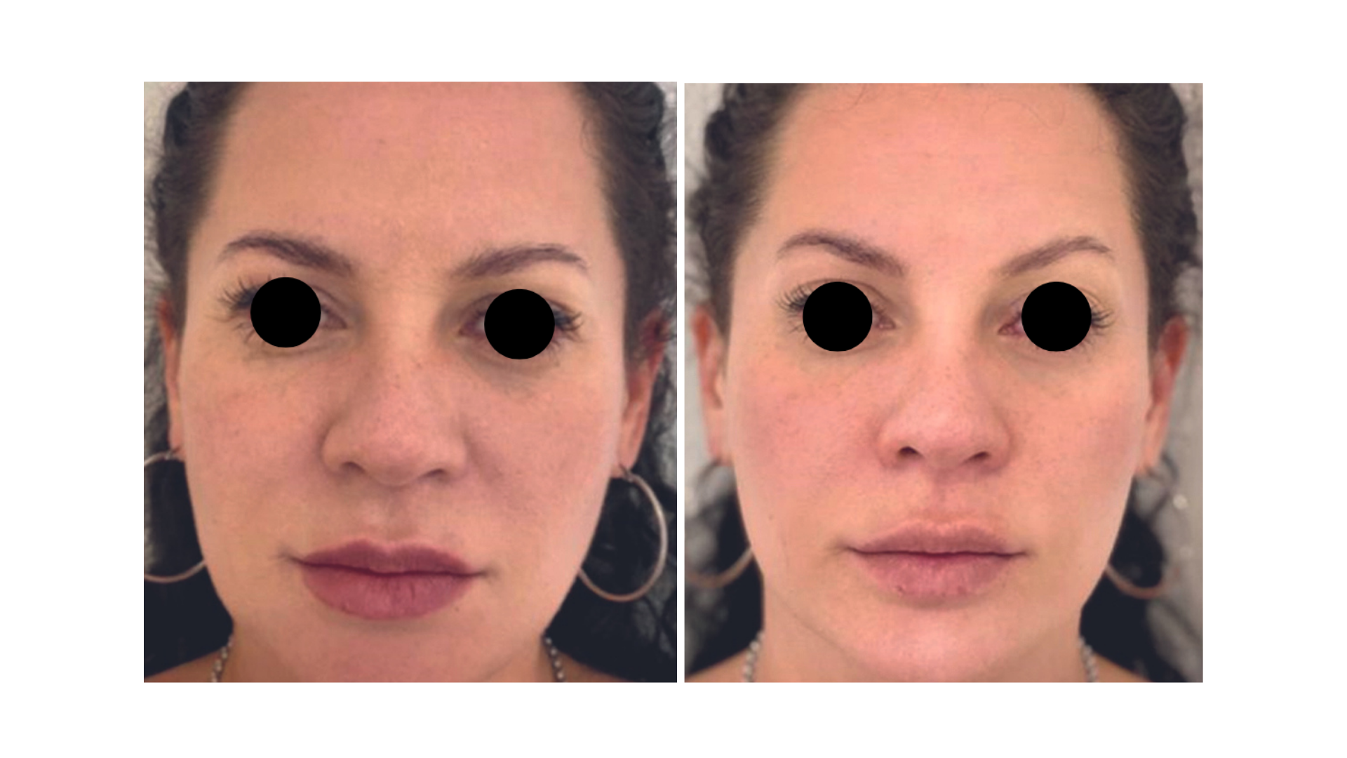 Fotona VectorLift®