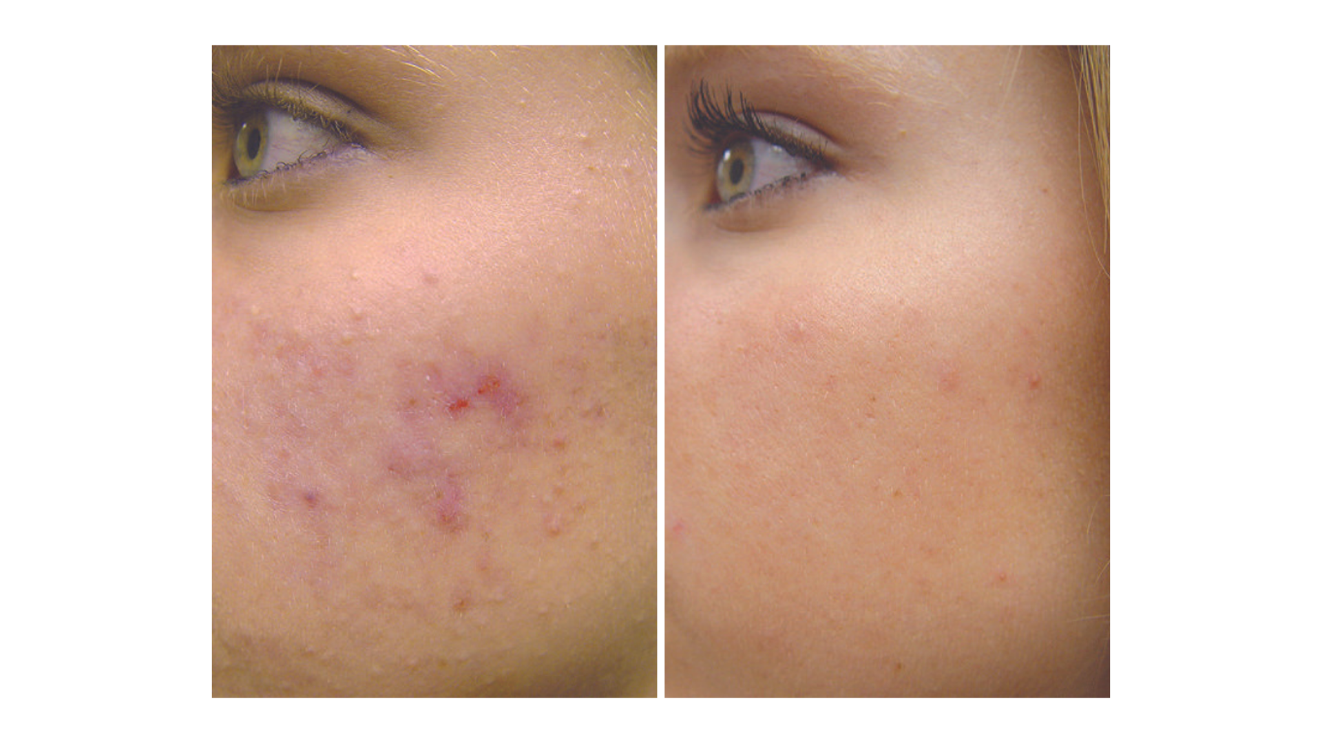 Active Acne Treatment