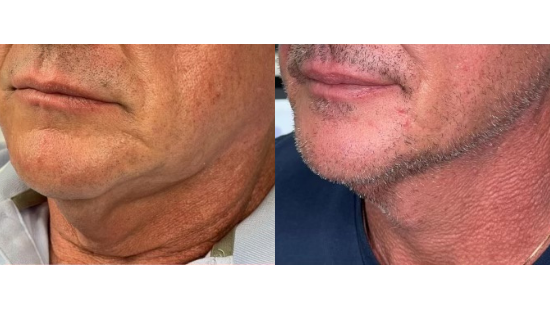 Fotona TightSculpting®