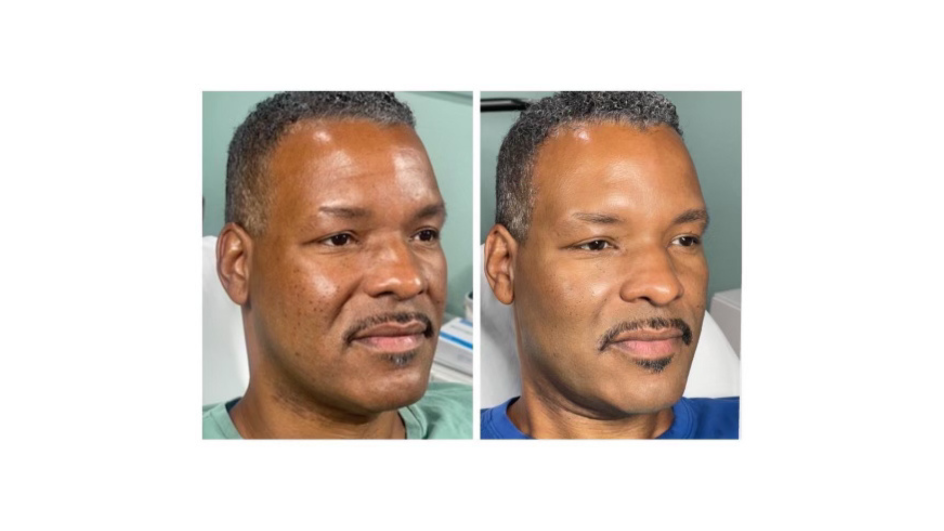 Skin Resurfacing