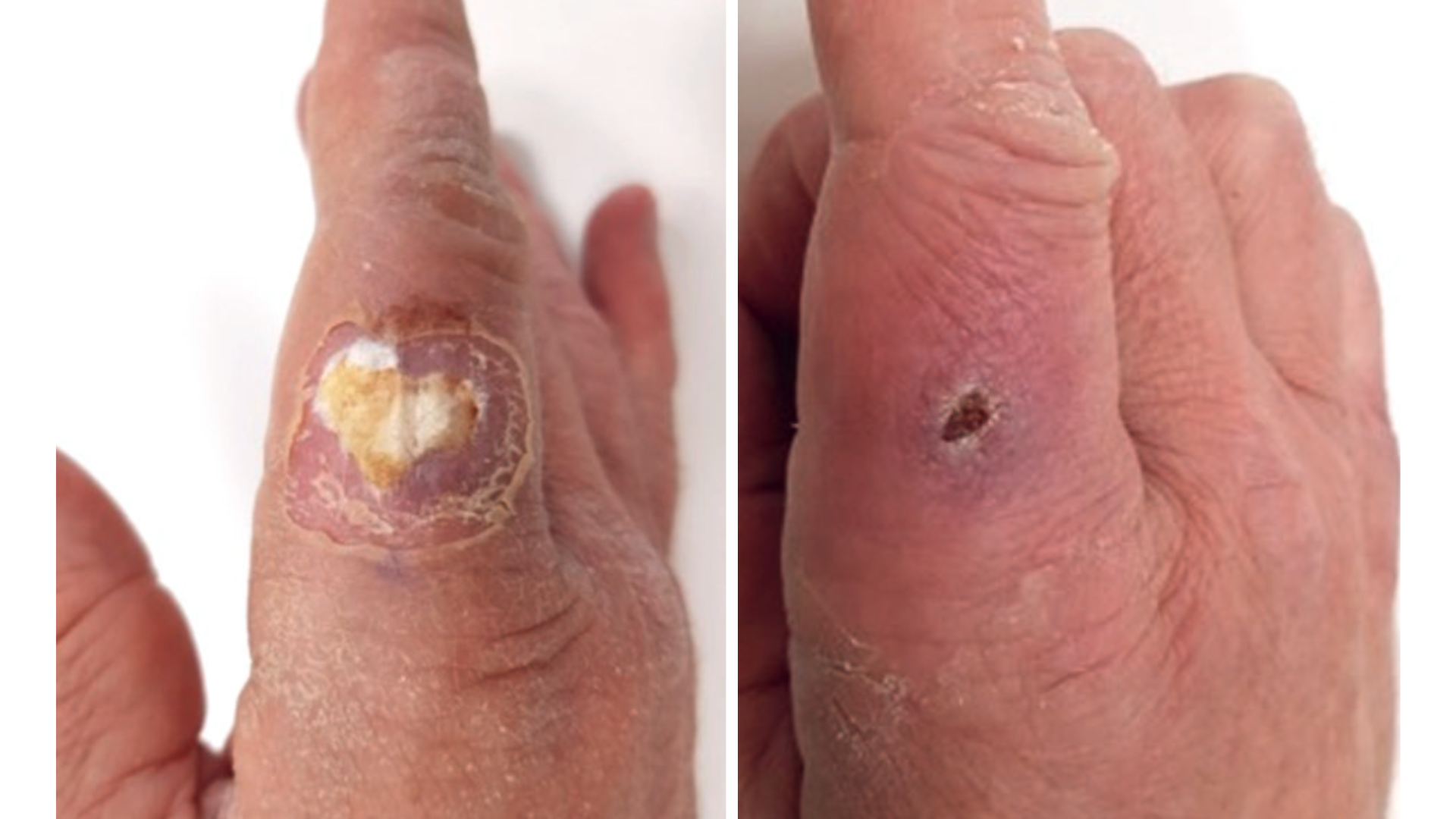 Wound Treatment