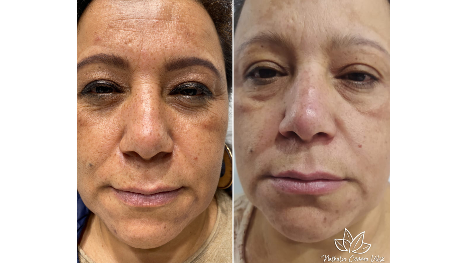 Fotona® Melasma Treatment