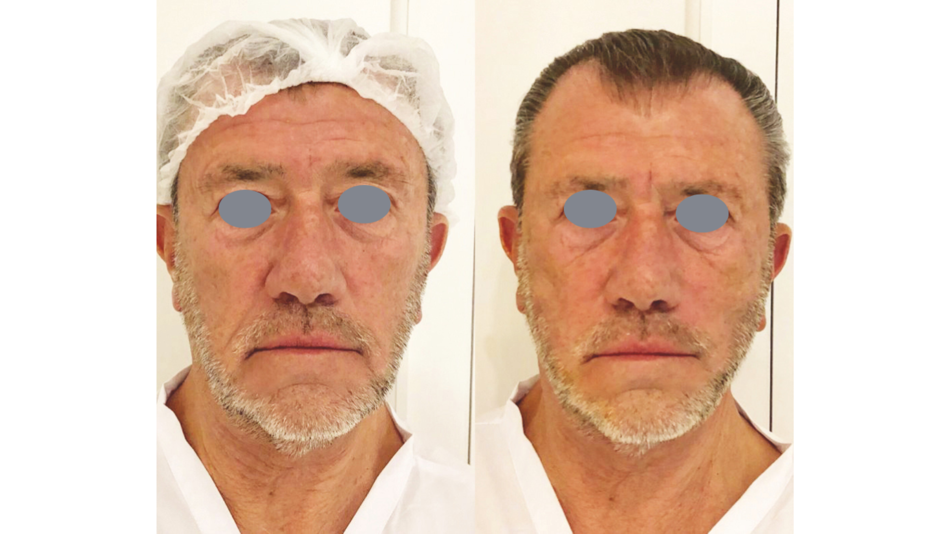 Fotona4D®Men