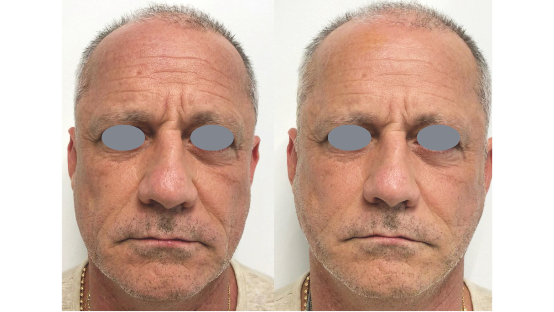 Fotona4D®Men