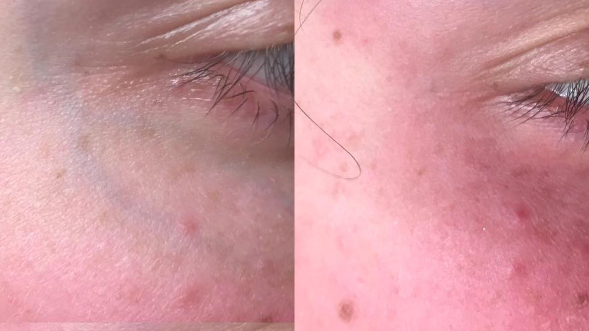 Facial Vascular Lesion Removal