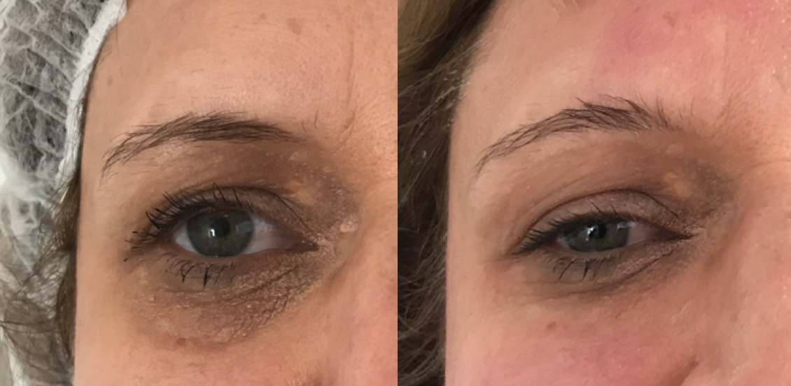 Panda Eye Treatment