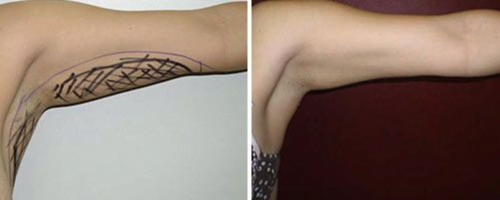Laser Lipolysis