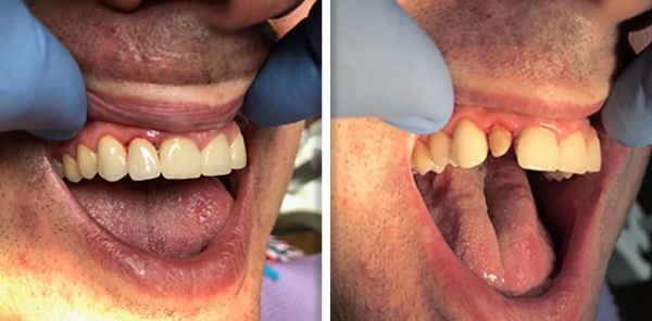 Laser Assisted Ceramic Debonding