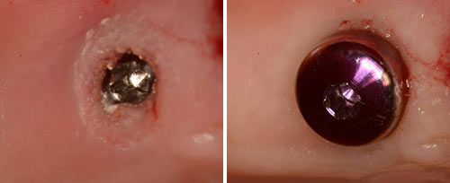 Implantology