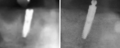 Peri-Implantitis