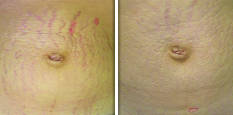 Stretch Mark Revision Treatment