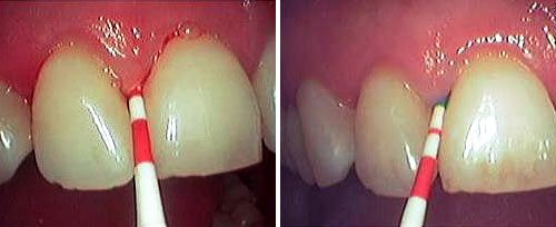 Soft-Tissue Curettage Debridement