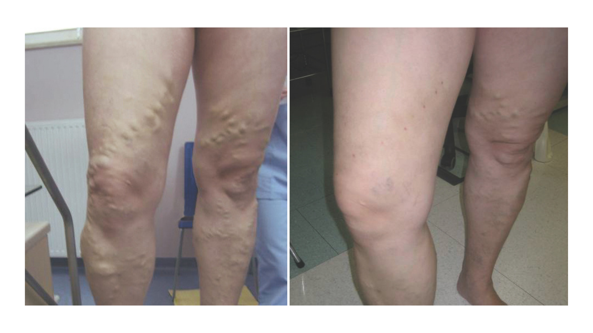 Fotona® Endovenous Laser Ablation Treatment (EVLA)