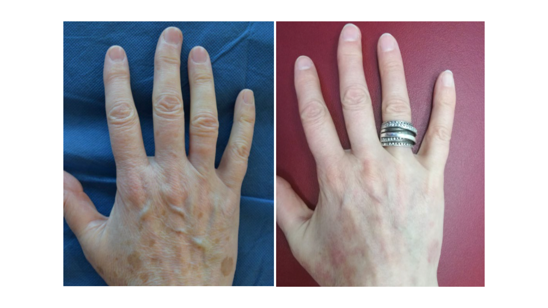 Pigmented Lesions