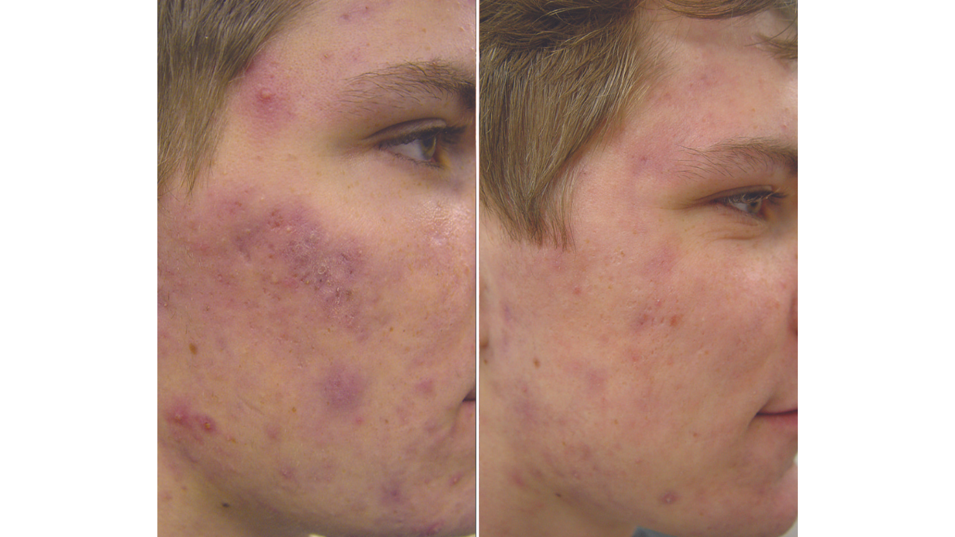 Active Acne Treatment
