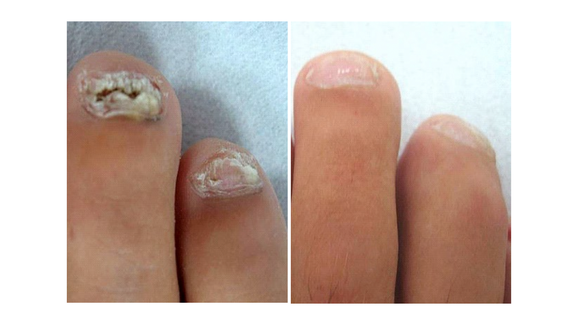 Fotona® ClearSteps