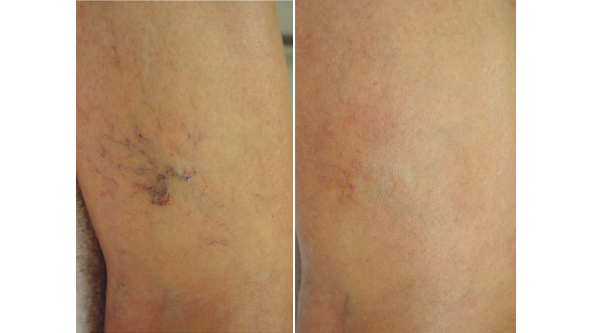 Vascular Lesions