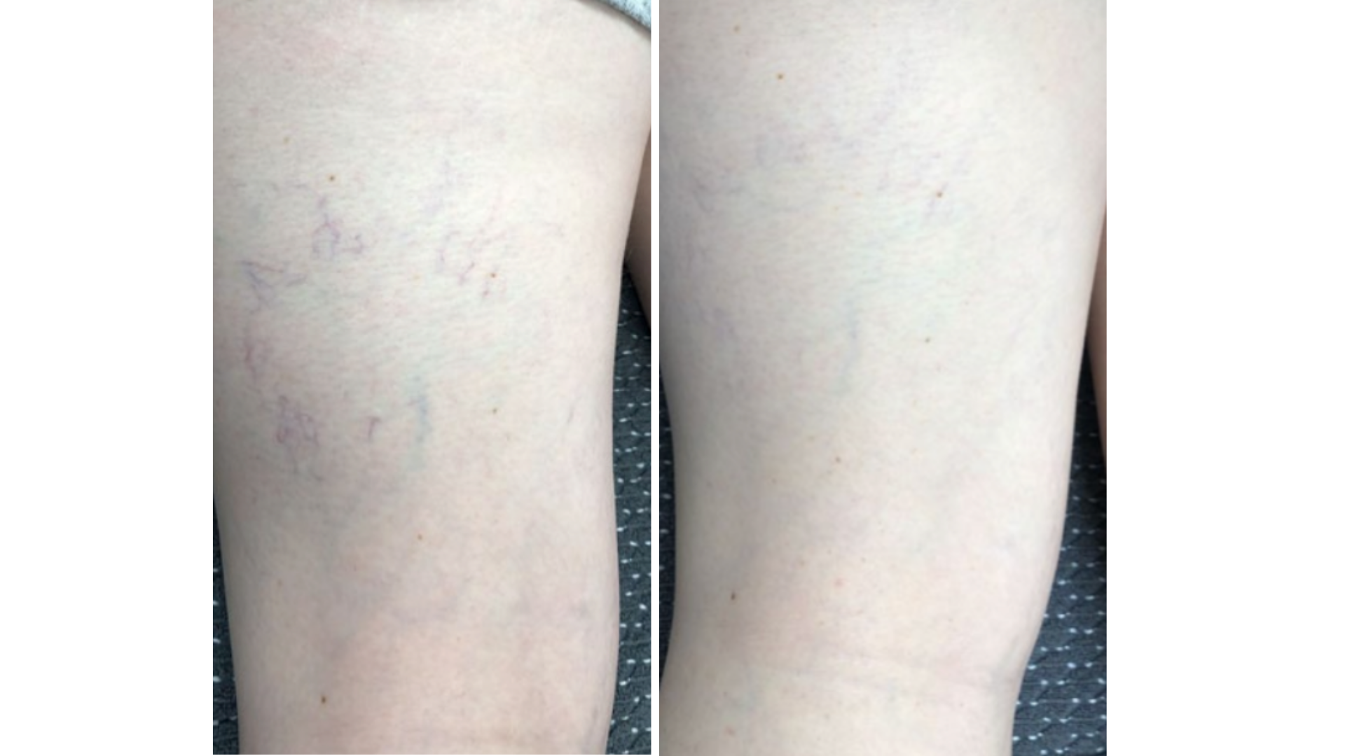 Vascular Lesions