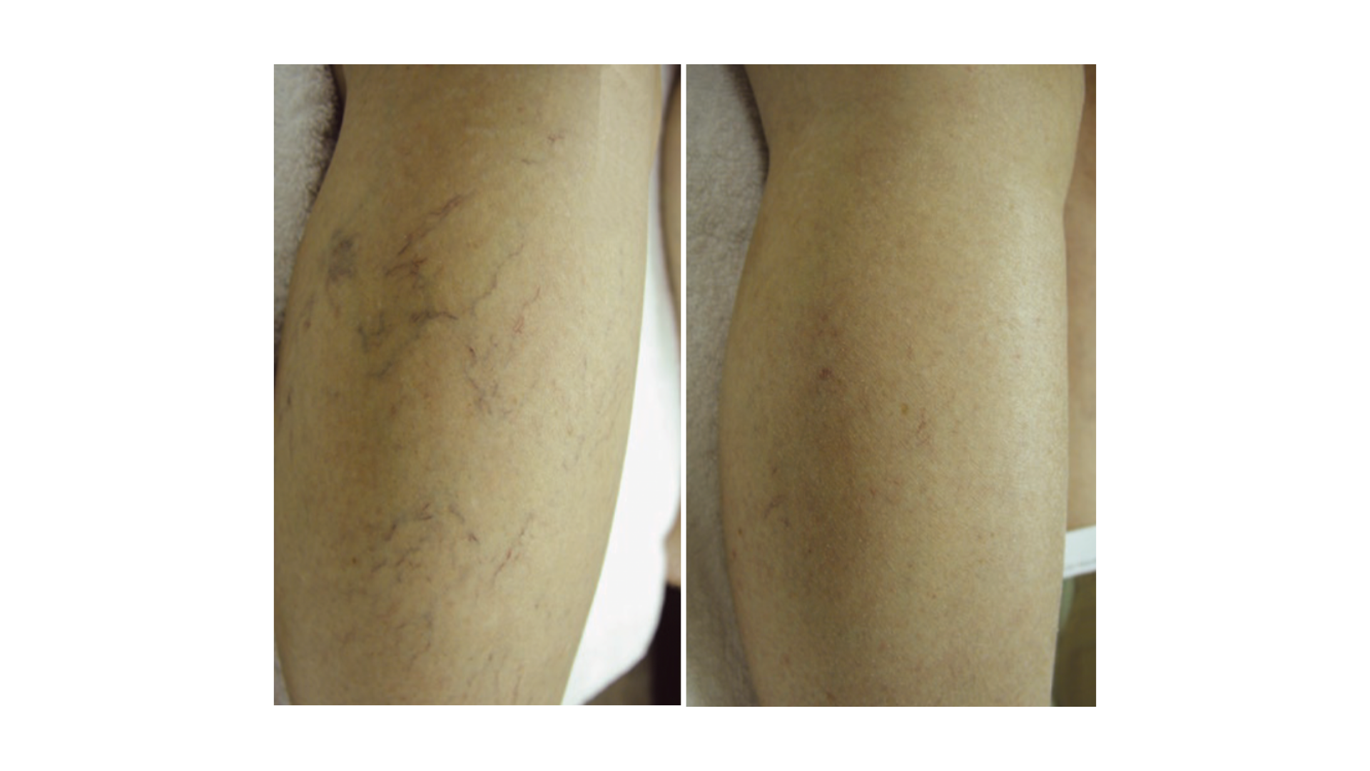 Vascular Lesions