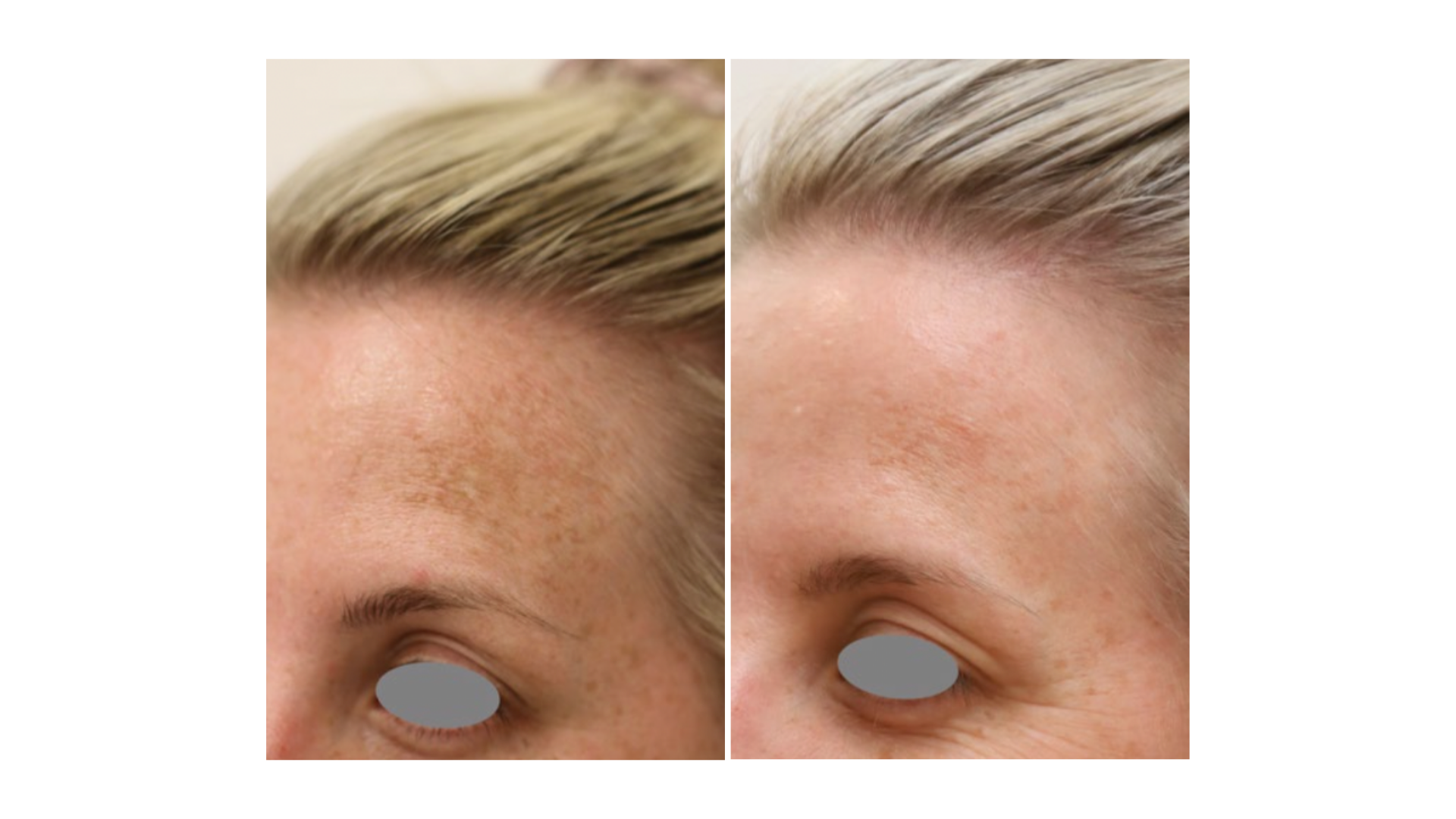 Pigmented Lesions