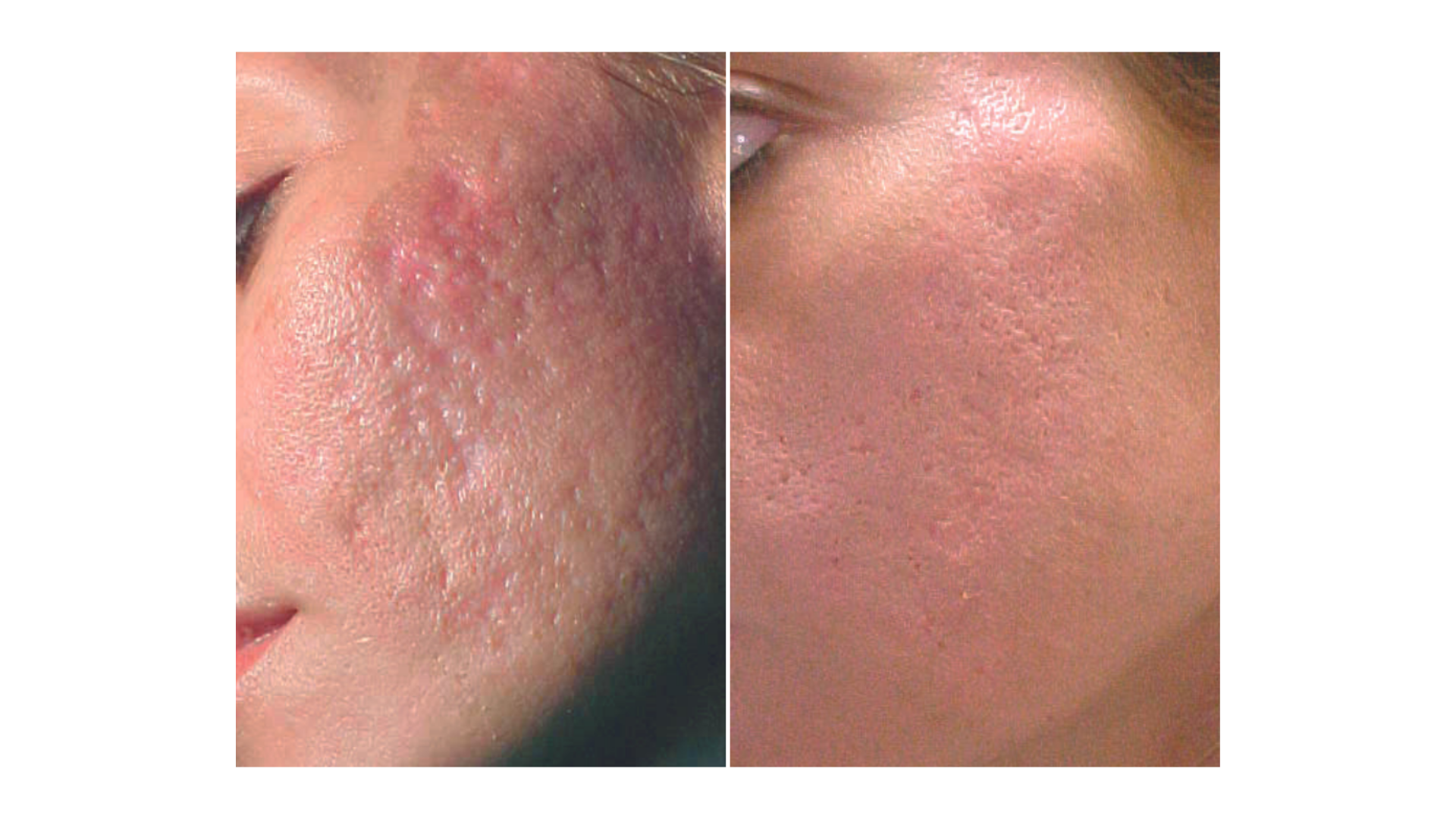 Acne Scar Revision Treatment