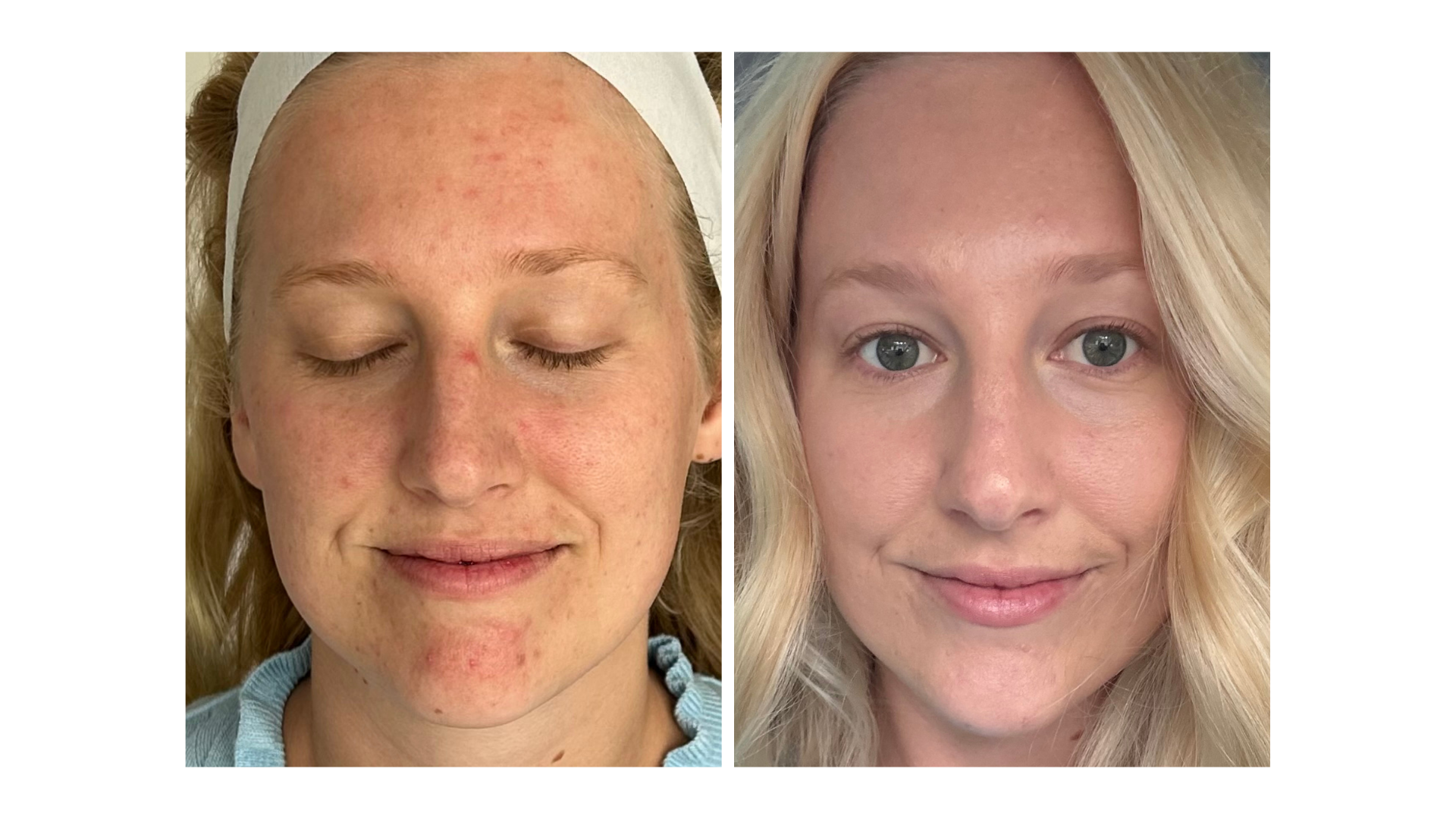 Active Acne Treatment