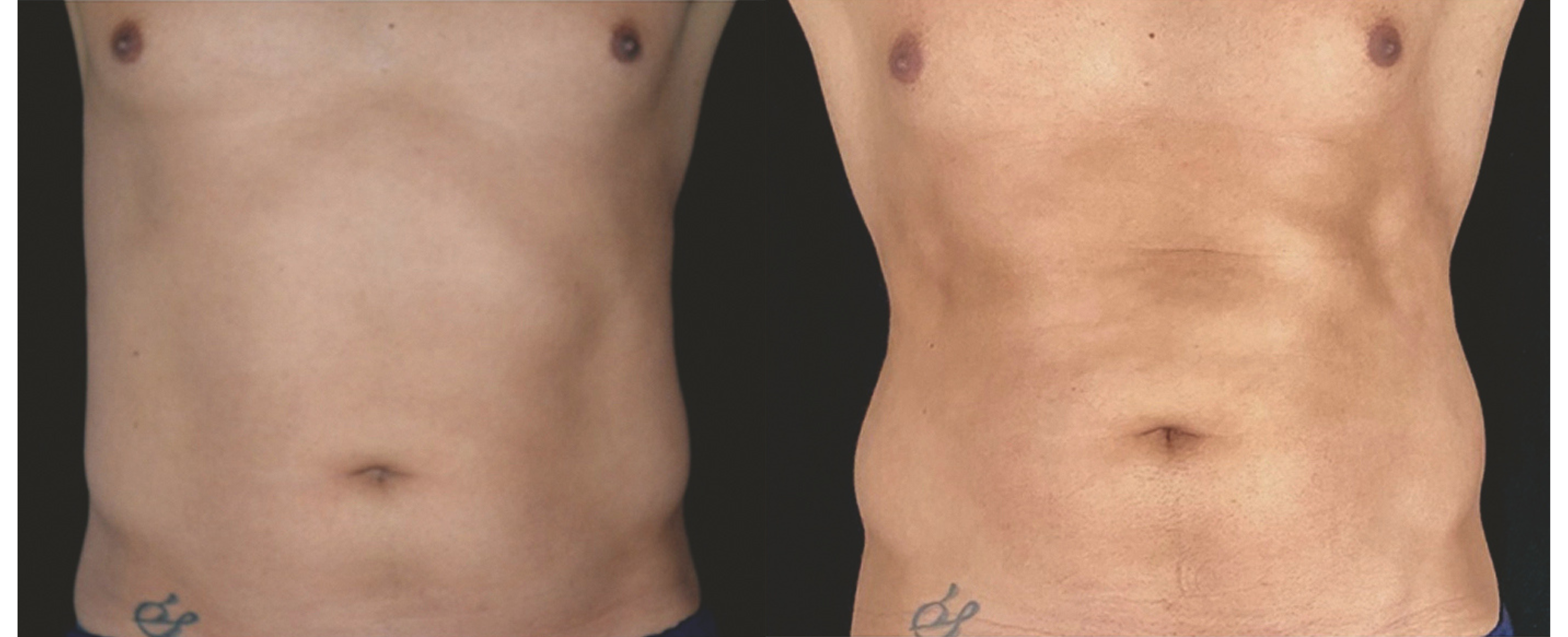 Fotona CoreRestore™