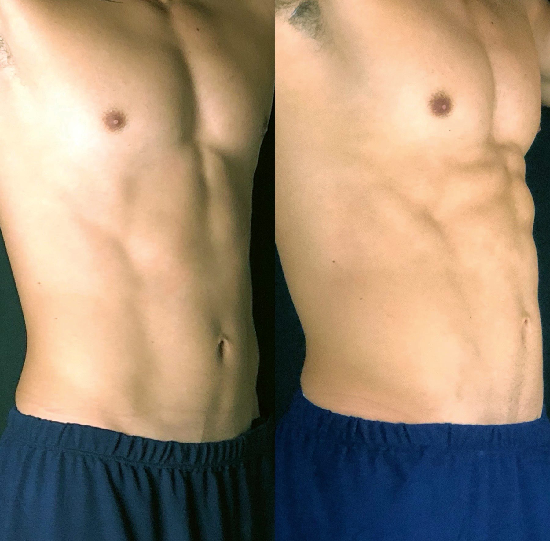 Fotona CoreRestore™