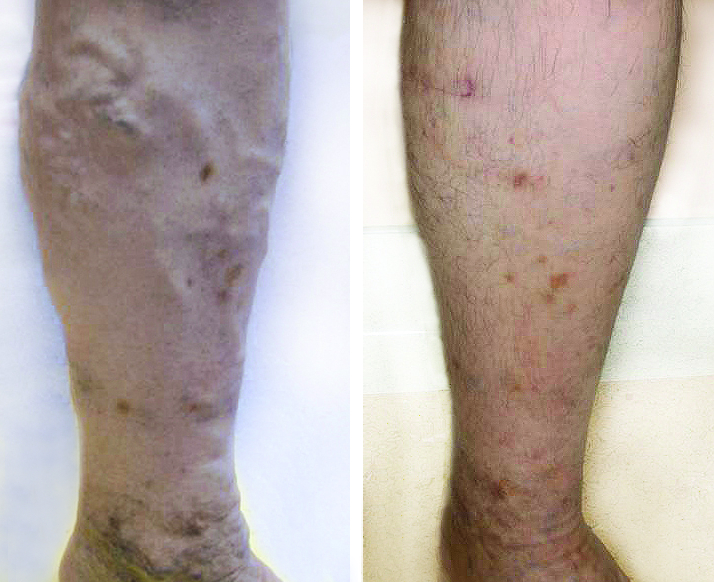 Fotona® Endovenous Laser Ablation Treatment (EVLA)