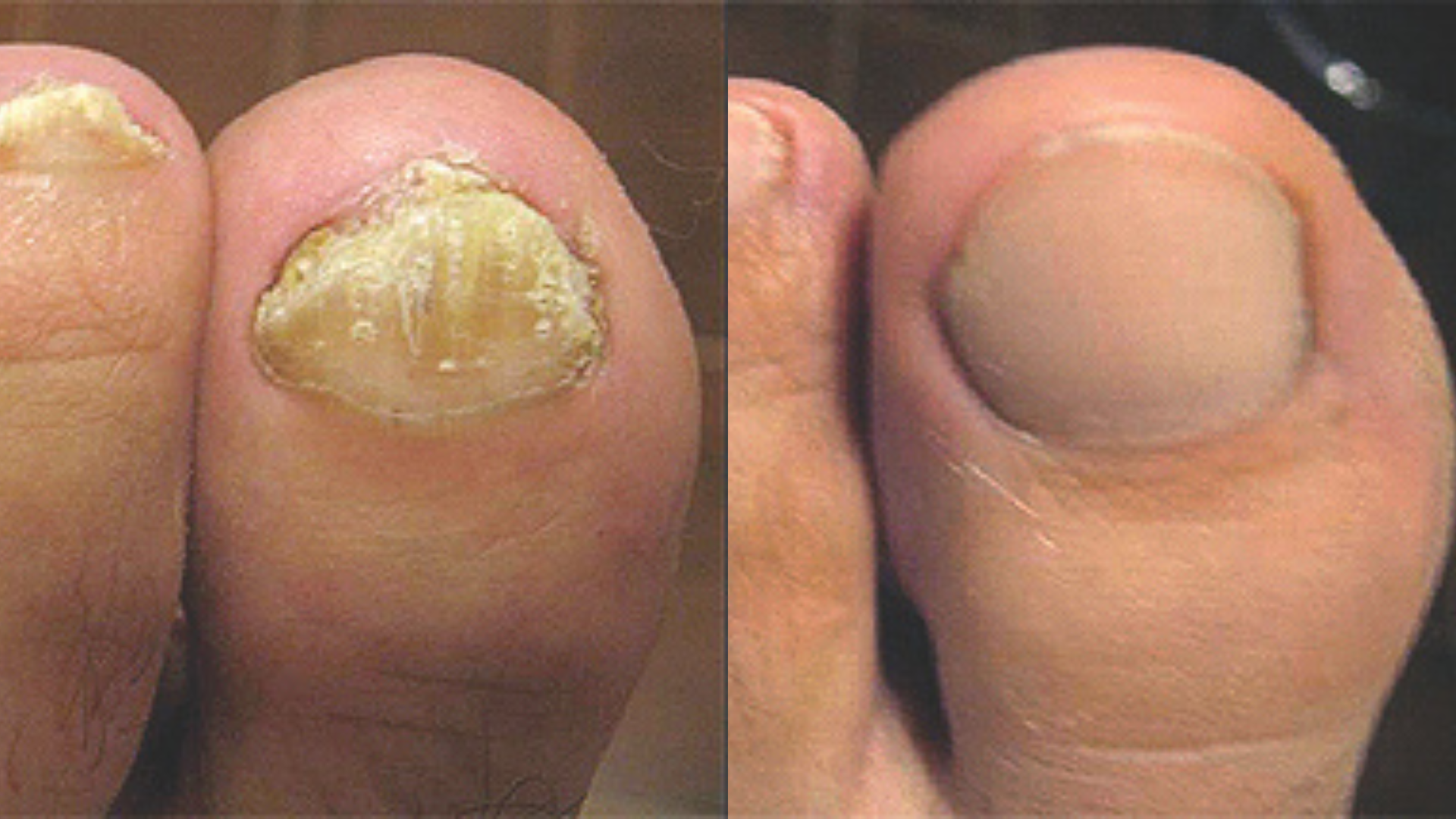 Fotona® ClearSteps