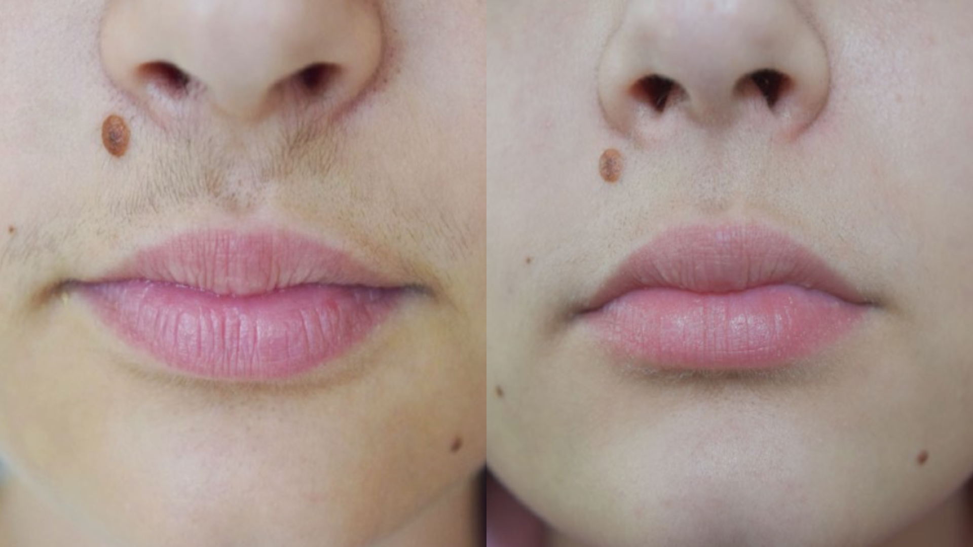 Facial Hair Reduction