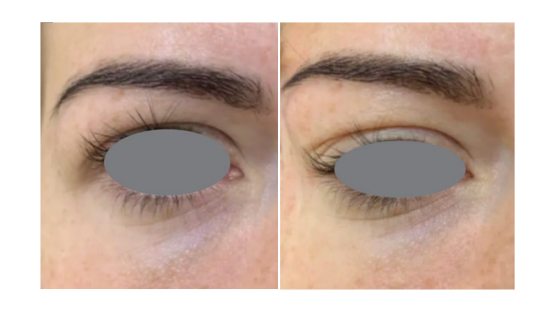 Fotona VectorLift®
